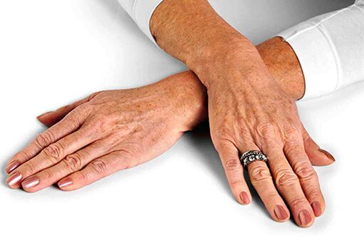 Hand skin with age-related changes requiring the use of rejuvenation techniques