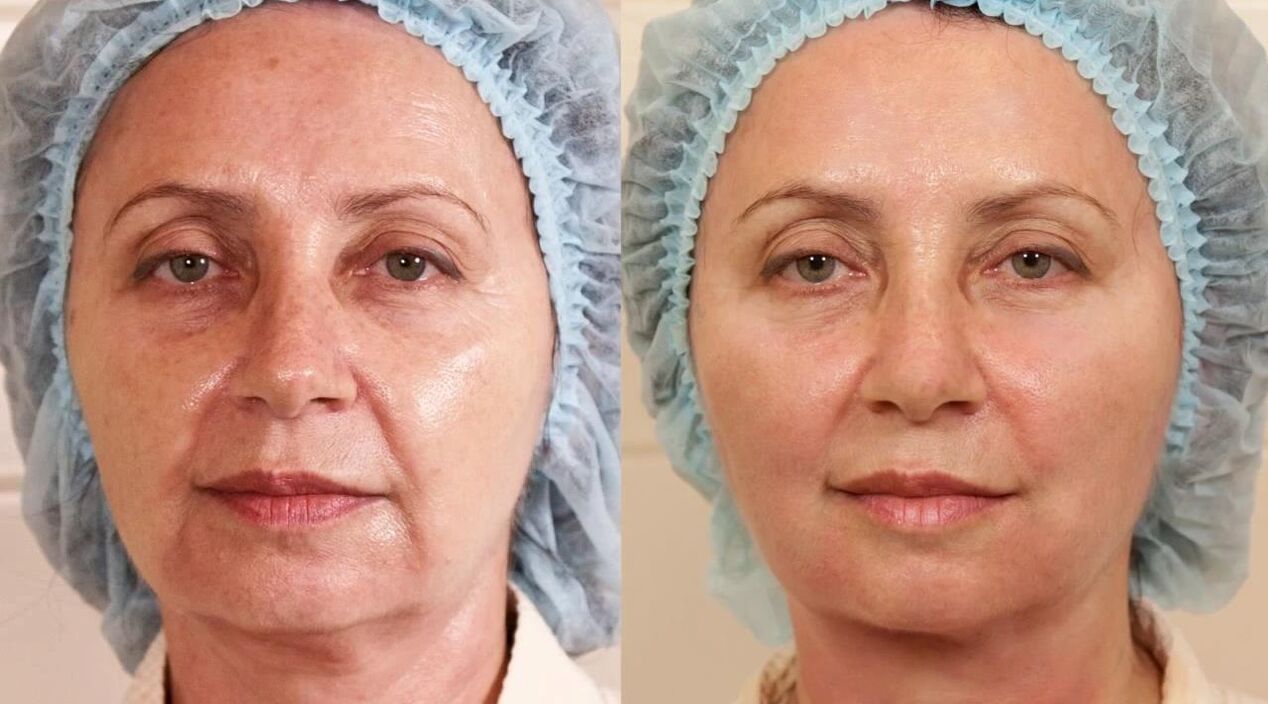 photos before and after facelifting