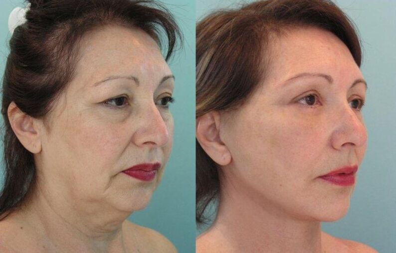 Result of facial skin rejuvenation threading