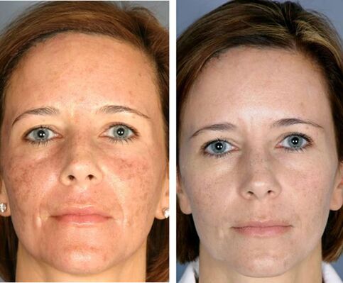Before and after fractional thermolysis of the face