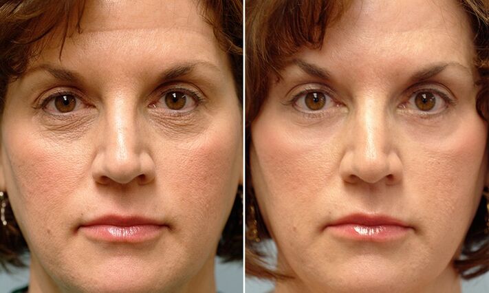 person before and after laser fractional rejuvenation
